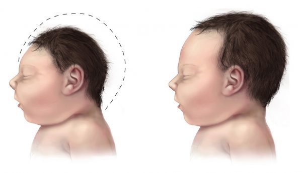 Side-view illustration of a baby with microcephaly (left) compared to a baby with a typical head size